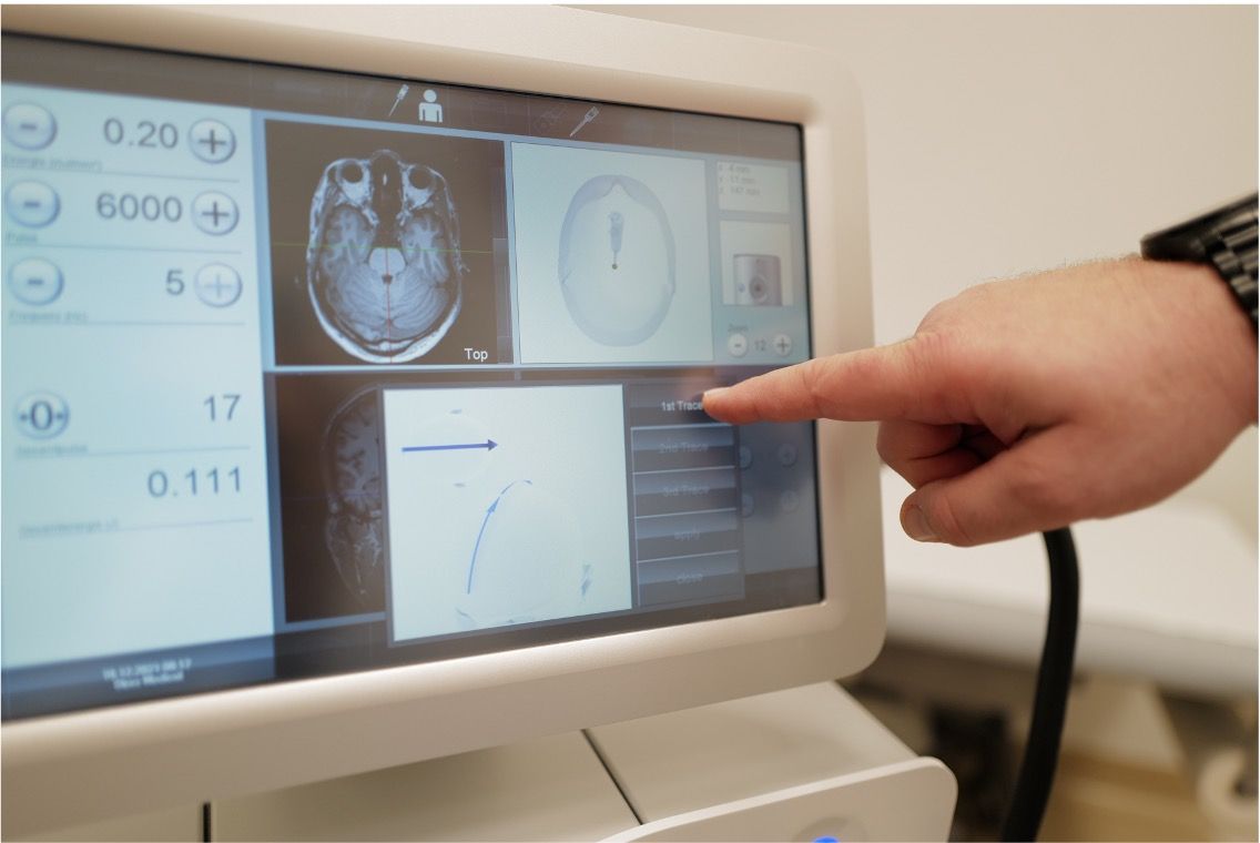 Behandlung Transkraniellen Pulsstimulation